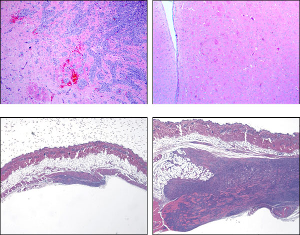 The two faces of Stat3. The oncogene (top): when EGFR—a cell-surface receptor—mutates in glioblastoma, the Stat3 protein becomes oncogenic, promoting tumor growth. The image on the top left shows EGFR-mutated cancerous tissue in which Stat3 is active and therefore advancing tumor development. The image, top right, shows the same tissue without Stat3 activity; the result is a healthier sample. The tumor suppressor (bottom): in other subtypes of glioblastoma, Stat3 functions as a tumor suppressor gene. In these tissue samples, the cancer has lost the tumor-suppressor PTEN, leaving that function almost entirely up to Stat3. In the bottom left image, an active Stat3 holds the cancer at bay. But when Stat3 is lost, bottom right, the tumor grows. Courtesy Azad Bonni.