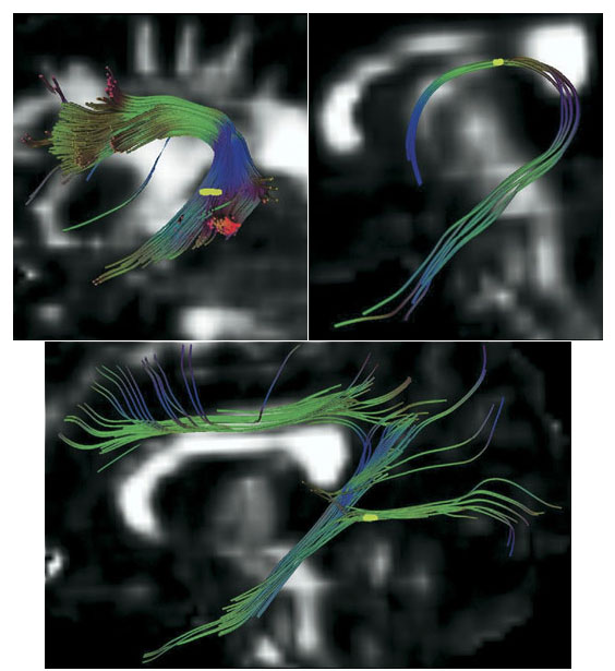 Brain interrupted. Tractography analyses based on diffusion tensor imaging reveal fiber pathways in the brain. A reduction in a measure of fractional anisotropy indicates a disruption in the directional flow of water molecules along the axonal fibers in the brain’s white matter. In subjects who experienced parental verbal abuse, disruptions (yellow) appear in three pathways (clockwise from top left): the arcuate fasciculus, the left fornix, and the cingulum bundle. The disruptions could be caused by decreased axonal diameter in neurons or indicate diminished myelin sheathing possibly caused by stress on nearby glial cells. Additional analyses plus higher resolution images will help researchers pinpoint the problem. Courtesy Biological Psychiatry and Jeewook Choi.