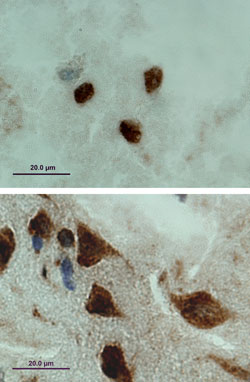 Signs of disease. A mutant form of the FUS/TLS gene taken from a patient with the genetically dominant form of familial amyotrophic lateral sclerosis (ALS) was introduced into cell lines. Normally, the protein remains in the nucleus (top), but in the modified cells, it collected in the cytoplasm (bottom). 
