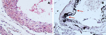 Signs of aging. Sections of aorta taken from mice fed a normal-phosphate diet (left) and a high-phosphate diet (right) show aortic calcification (arrows) in mice on the high-phosphate diet.
