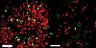 Window on T cell behavior. Islet transplants in control mice (left) versus mice given a treatment that promotes tolerance (right) appear 12 days after transplantation. Red-colored cells are destructive T cells (Teffs), and green cells are protective T cells (Tregs). While the number of protective cells does not appear to be significantly different, the number of destructive cells infiltrating transplants is much higher in the transplant-rejecting (control) mice than in the transplant-tolerating (treated) mice. Images courtesy of Maria Koulmanda.
