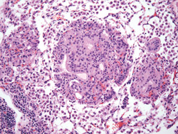 Multiple independent lung tumors metastasized from breast cancer PinX1 mutant mice. That’s a rare development in single-gene knockout mouse tumor models, says Roderick Bronson, an HMS lecturer on pathology who collaborated with researchers at Beth Israel Deaconess Medical Center. Photo courtesy of Beth Israel Deaconess Medical Center