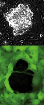 (Top) Ovarian cancer cells, in white, use physical force to push their way through a layer of mesothelial cells. (Bottom) The mesothelial cells, labeled green, are left with a gaping hole, the result of the bullying cancer cells. Images by Marcin Iwanicki and Rachel Davidowitz. 