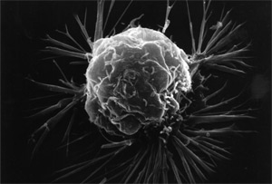 A breast cancer cell. Photo credit: National Cancer Institute