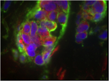 Breast cancer specimens reveal that the LOX gene plays an underlying role in promoting metastasis. Photo courtesy BIDMC