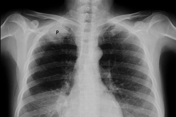 Chest radiograph showing a Pancoast tumor (labeled as P, non-small cell lung carcinoma, right lung), from smoker woman of 47 years old. Image by Share Alike, Creative Commons