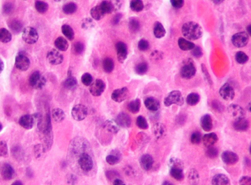 Malignant plasma cells. Photo: Nephron/Wikimedia Commons