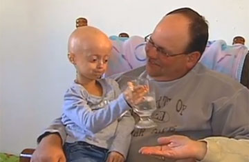 adults with progeria