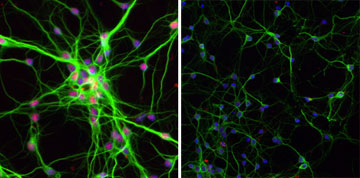 Normal dendrites (left) with PQBP1 stained red; dendrites after PQBP1 malfunctions (right). Image by Qingqing Wang