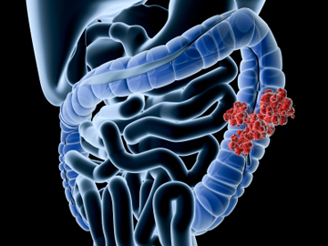 Finding Colorectal Cancer | Harvard Medical School