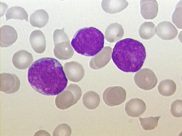 Researchers have uncovered a molecular connection between acute lymphoblastic leukemia (above) and Down syndrome. Image: Christaras A/Wikimedia Commons