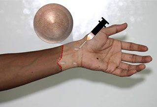 In a depiction of a hand transplant, researchers illustrate how injecting a hydrogel-drug combo beneath the skin results in a controlled release of immunosuppressant drug to prevent rejection of the transplanted limb. Image courtesy of Praveen Kumar Vemula