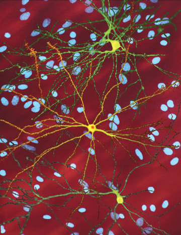 A montage of three images of single striatal neurons transfected with a disease-associated version of huntingtin, the protein that causes Huntington disease. Image: Steven Finkbeiner, the Gladstone Institute of Neurological Disease and the University of California, San Francisco, via NINDS and Wikimedia Commons