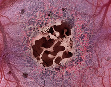 Microscopic view of the engineered bone with an opening exposing the internal trabecular bony network, overlaid with colored images of blood cells and a supportive vascular network that fill the open spaces in the bone marrow-on-a-chip. Image: James Weaver/Wyss Institute