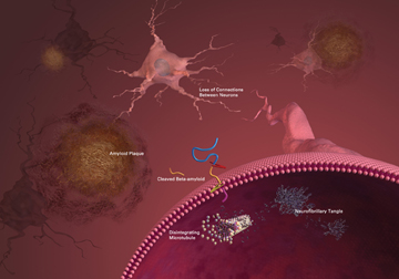 Characteristics of Alzheimer’s disease. Image: National Institute on Aging