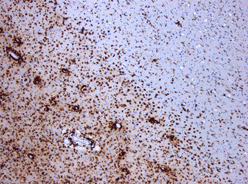 Photomicrograph of a demyelinating MS-Lesion. Image from Creative Commons