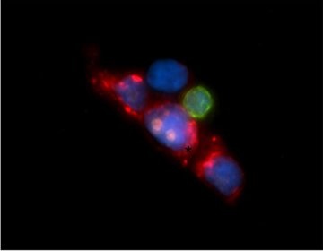 An earlier example of circulating tumor cells captured by a microfluidic isolation device. Image: Mass General