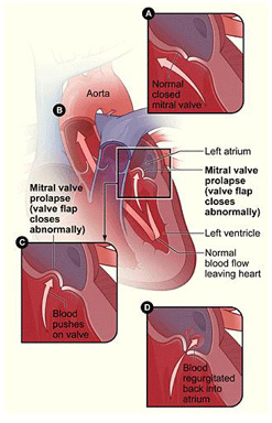 Mitral valve prolapse. Image: NIHLBI