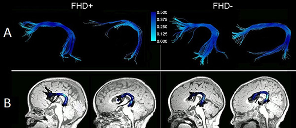 The arcuate fasciculus in a child with a family history of dyslexia (L) versus no family history (R), as seen on DTI. Image: Nicolas Langer and Barbara Peysakhovich