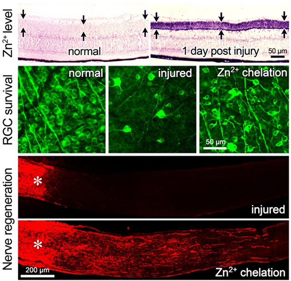 Top row: Cross sections through the retina show very little free zinc (purple staining) in normal mice. But within an hour after optic nerve injury (right), zinc begins to accumulate in the retinal layer where amacrine cells connect with the retinal ganglion cells (RGCs). Over the next two days, the zinc transfers to the RGCs themselves, and these neurons die and cannot regenerate their damaged axons. Second row: Treatment with chelating compounds allows many damaged RGCs to survive for months after the optic nerve is injured. The retina treated with chelation (far right) is shown two weeks after injury. Bottom row: The optic nerve two weeks after injury. Without treatment, no axons regenerate beyond the injury site (asterisk), whereas zinc chelation leads to extensive regeneration. Images: Boston Children’s