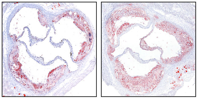 athlerosclerosis