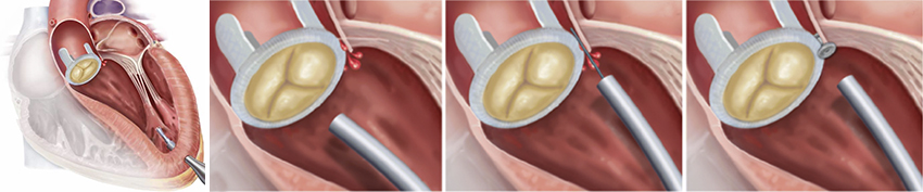 Series of illustrations shows a tube entering a heart and a plug sealing a leaky valve