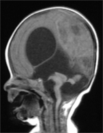 An MRI of a child with Walker-Warburg syndrome shows abnormal brain features. Image courtesy of Hans van Bokhoven of Radboud University Medical Center. 