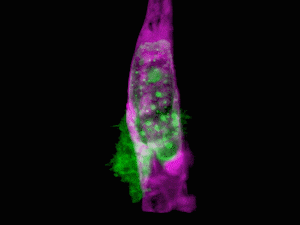 A cancer cell (green) forces its way through the wall of a blood vessel (purple)