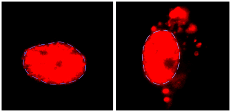  Normally, U2-snRNP (red) is found in the nucleus of motor neurons (left), but accumulates outside the nucleus in ALS or FTD patient-derived neurons with C9ORF72 mutation. Image: Reed lab/HMS 