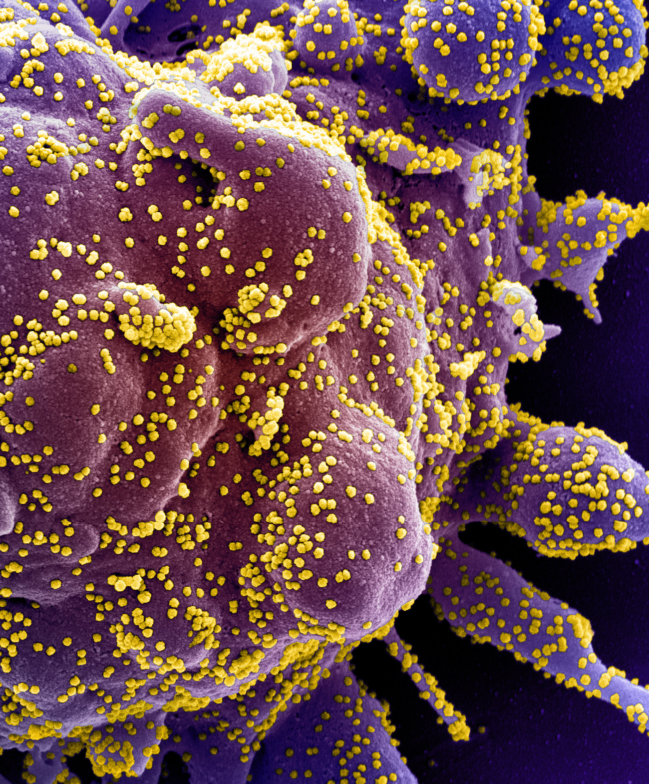 cell destroying itself after infection with SARS-CoV-2 (yellow)