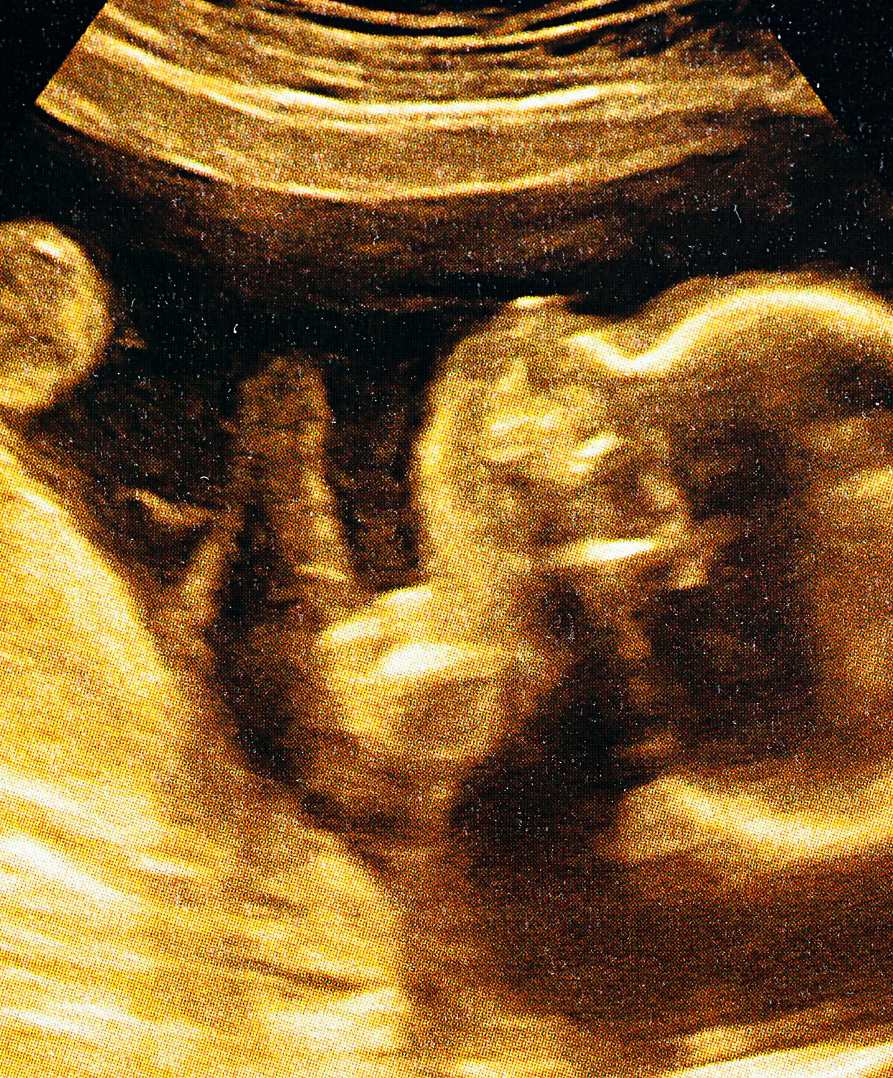 ultrasound image of a fetus