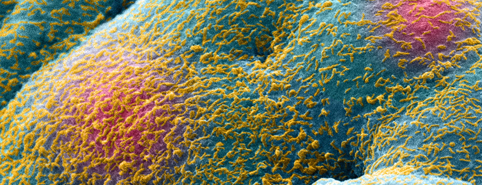colorized prostate cancer cells showing cell bodies, nuclei, and cell extensions