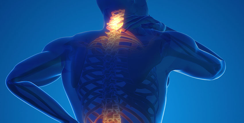 Illustration of human back with areas of inflammation highlighted