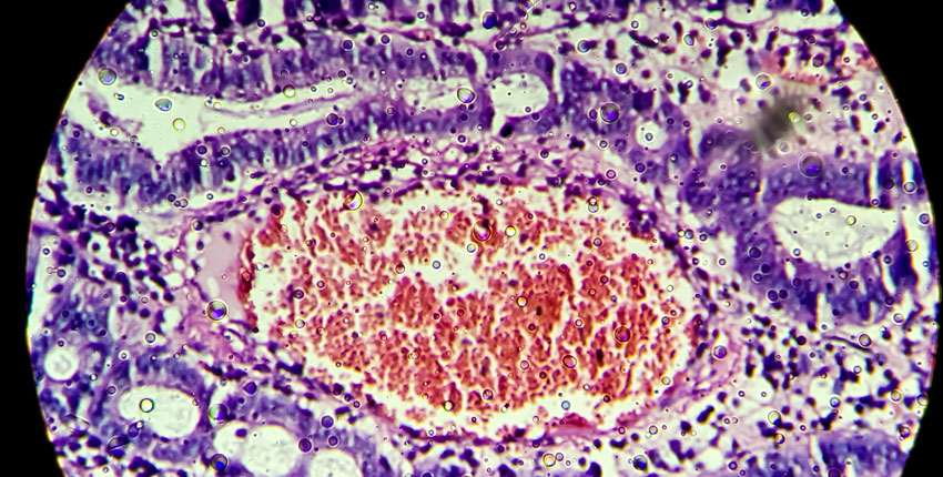 Microscopic image of colonic adenocarcinoma. Image: Md Ariful Islam/iStock/Getty Images Plus