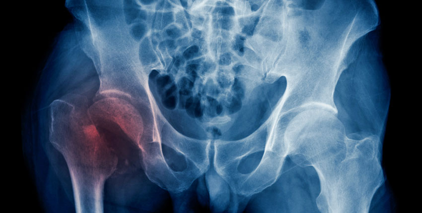 X-Ray image of a human hip with right join reddish colored 