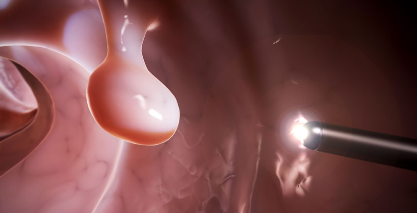 Illustration of a polyp inside of a colon with a laparoscopic light near it 