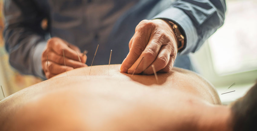 An acupuncturist inserts needles into a patient's back