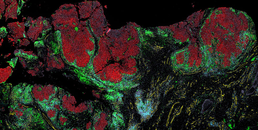 Patches of red melanoma cells surrounded by layers of blue and green immune cells. 