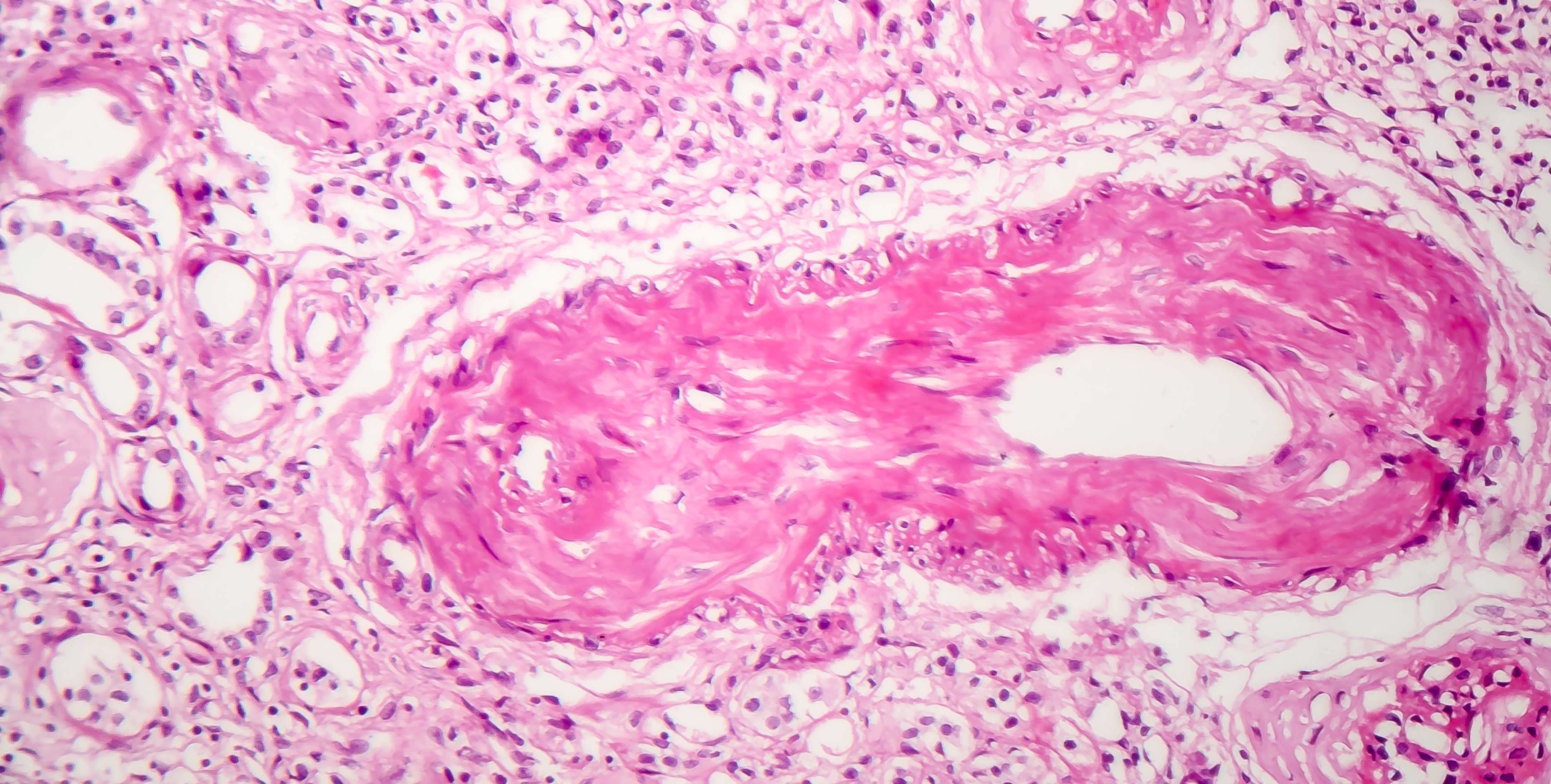 Contracted kidney, light micrograph 