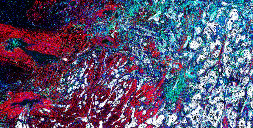 A close up image of a lung cancer tumor, composed of patches of red, white, blue, and green cells