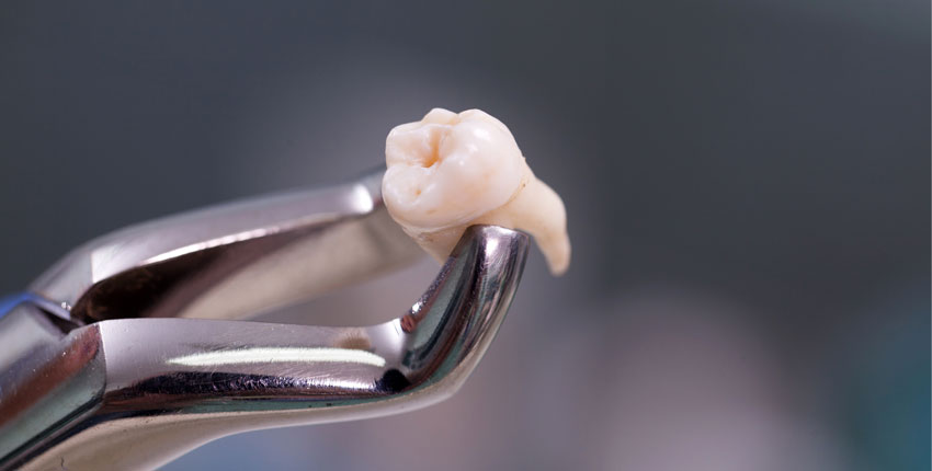 Photo of a dental tool holding an extracted tooth
