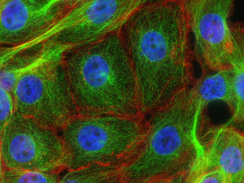 Stress fibers and microtubules in human breast cancer. Vivid blue clusters surrounded by green and red filaments