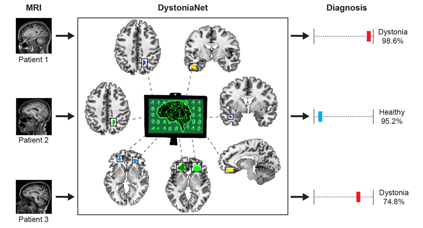 schematic showing diagnosis of dystonia in brains of three patients