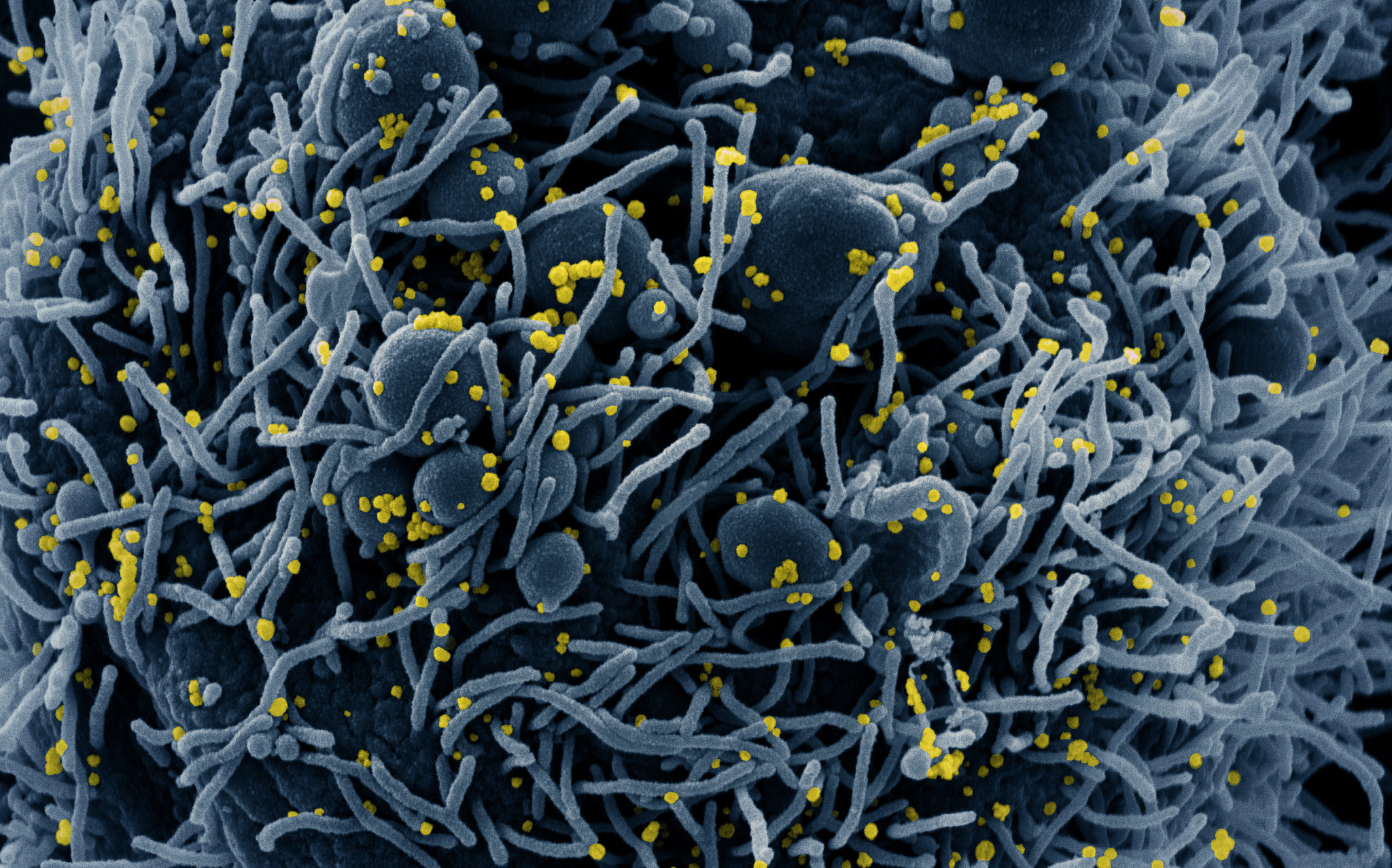 Electron microscopy image of SARS-CoV-2 tinted blue