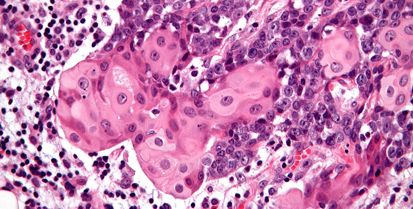 Purple and pink stains show abnormal cells
