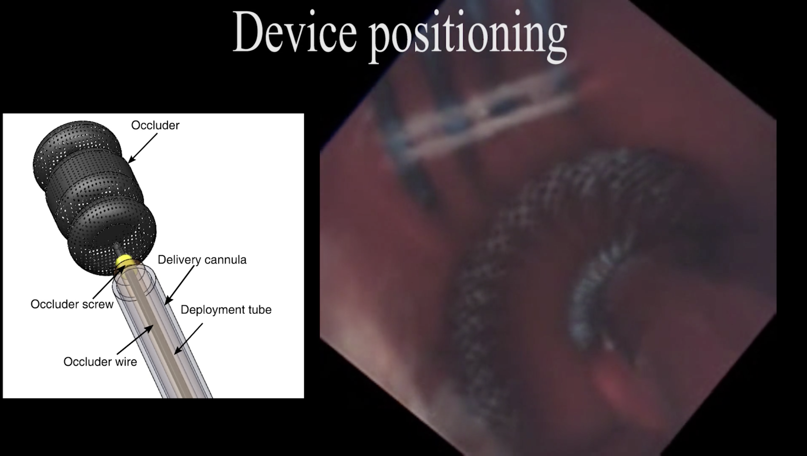 Image of plug next to live video inside a heart