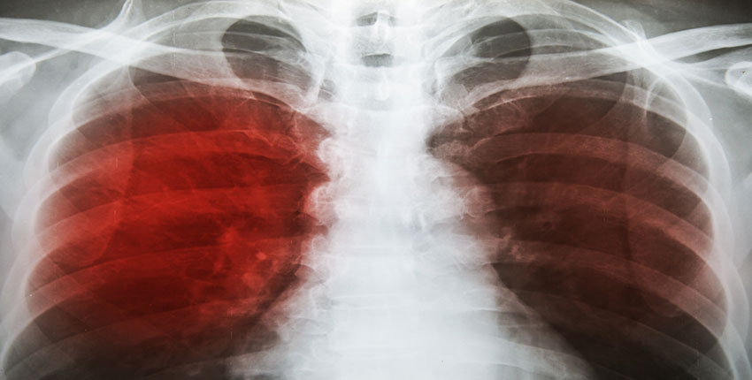 X-ray of infected lungs