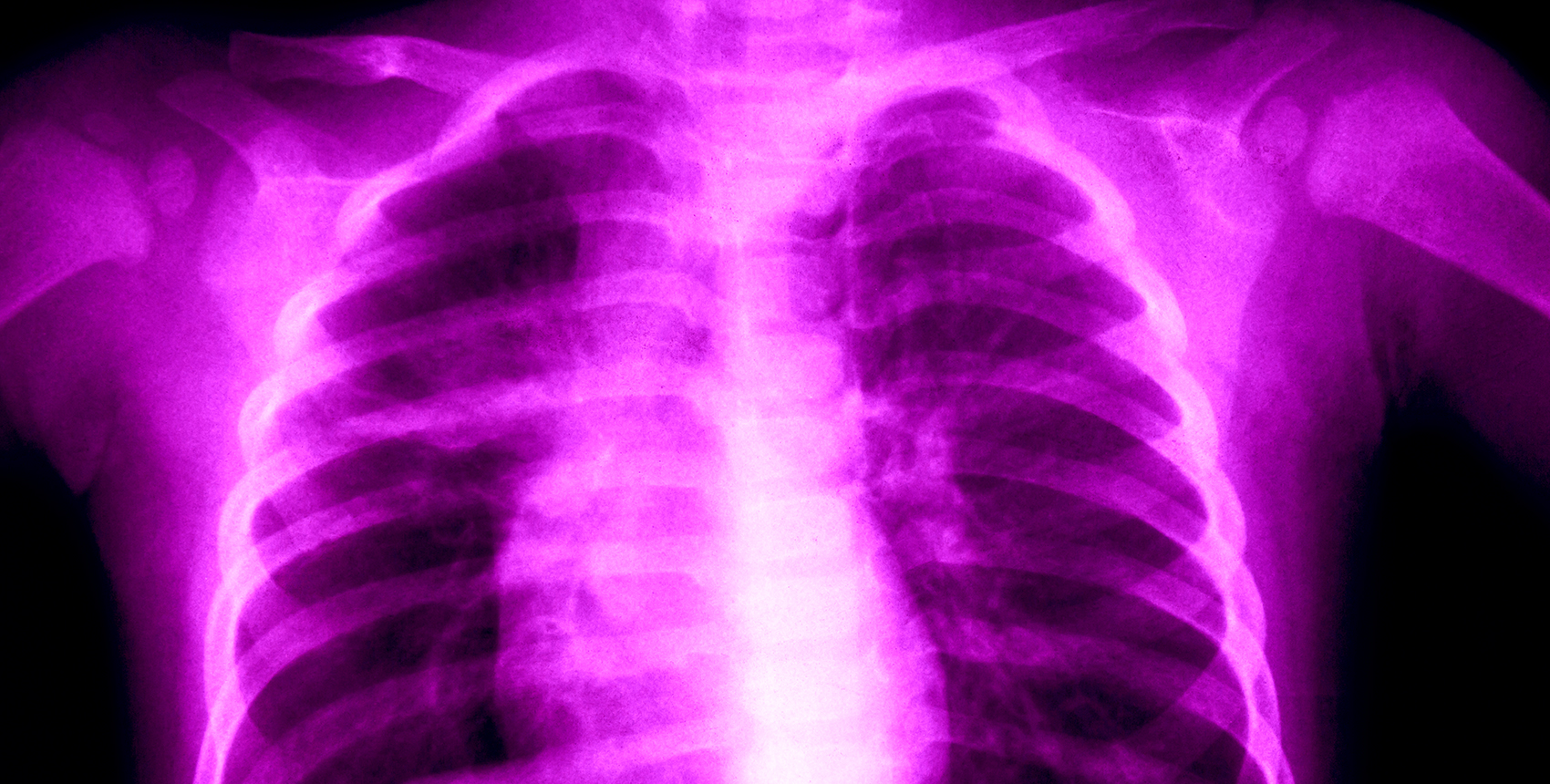 Colorized x-ray image of lungs.