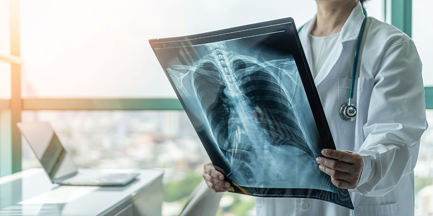 physician looking at an X-ray image of the lungs