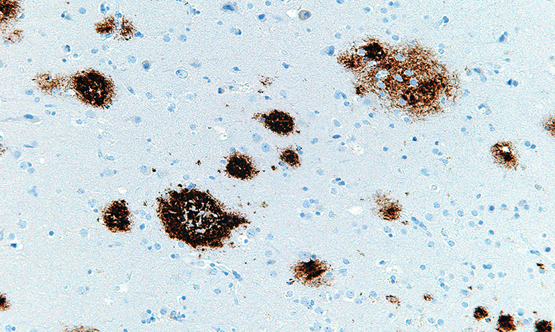 amyloid beta plaques